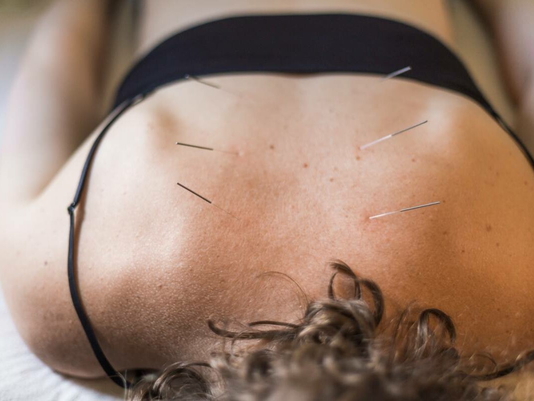 acupuncture needles upper back